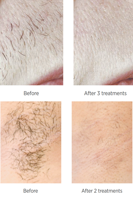 Laser Hair Removal in Leigh on Sea | Leigh Sanctuary